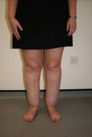 Figure 9 – Lipoedema of the legs with ‘shouldering’ at the ankles